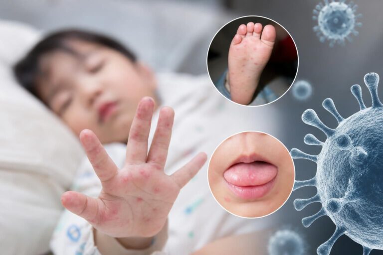 [수족구병, 어린이, 물집] 기사 대표 이미지 - 영유아 수족구병 급증…의심 환자 2배, 여름 정점 앞두고 ‘주의 경보’